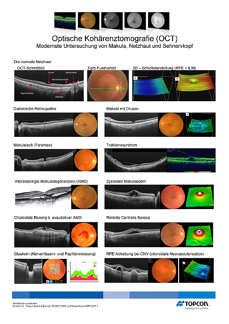 Optische Kohärenztomografie